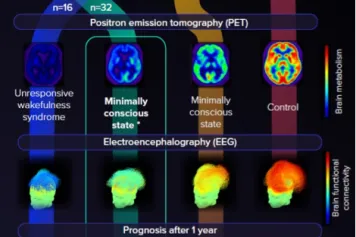 La plupart des patients post-comateux cliniquement non-répondants présentent une activité cérébrale résiduelle plus proche de celle que nous observons habituellement chez les patients en état de conscience minimale