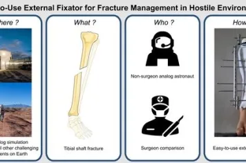 Un fixateur externe facile à utiliser dans tous les environnements hostiles, de l'espace à la médecine de guerre : est-ce que tout le monde pourra l'utiliser ?