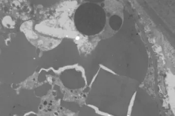 ? Atteinte rénale : difficulté diagnostique des MGRS 