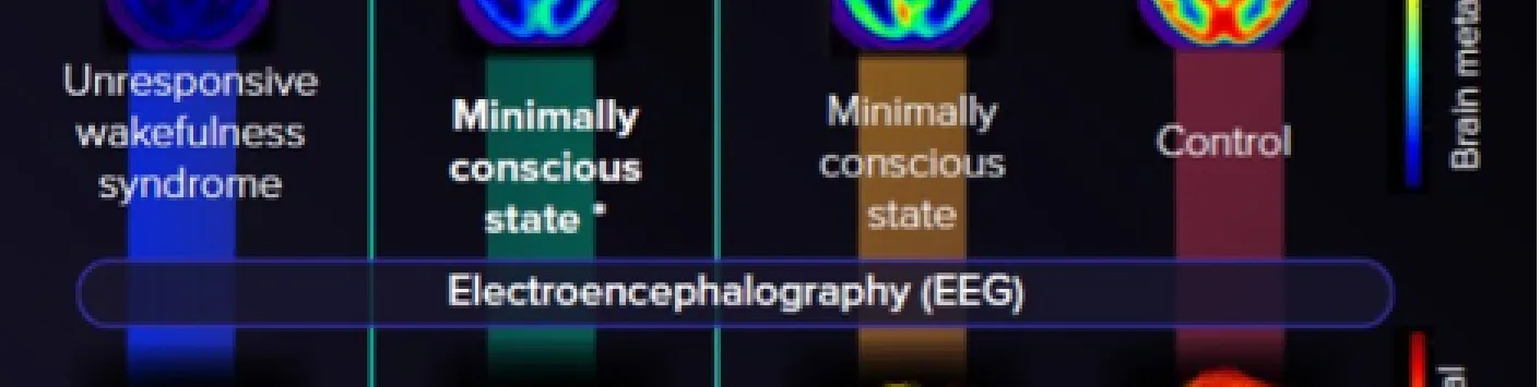 La plupart des patients post-comateux cliniquement non-répondants présentent une activité cérébrale résiduelle plus proche de celle que nous observons habituellement chez les patients en état de conscience minimale